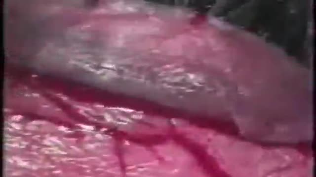 Eye Lid Partial Tarsectomy Surgery