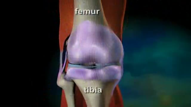 Osteoarthritis Video