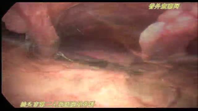 腹腔镜十二指肠球部溃疡穿孔修补术