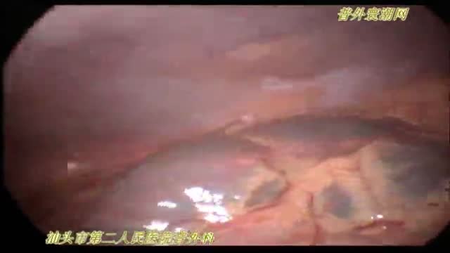 Laparoscopic duodenal ulcer perforation repair 2