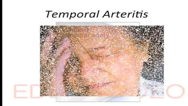 ⁣Temporal Arteritis