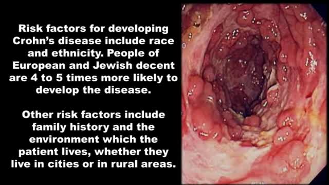 Crohn's Disease Symptoms Pain