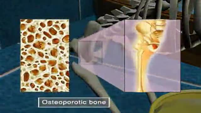 ⁣Osteoporosis