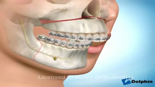 ⁣Dental Braces and Jaw Reconstruction