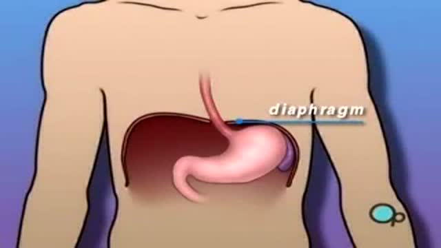 Hiatal Hernia 3D Medical Animation