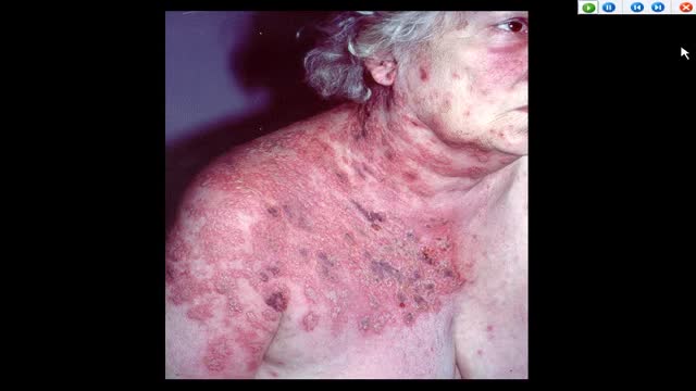 ⁣AUTO-HEMOTHERAPY IN HERPES CASES. THE STORY OF A DOCTOR IN FERME-NEUVE. CBC NEWS 1977