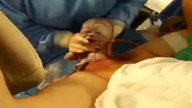 ⁣Twin Childbirth Video