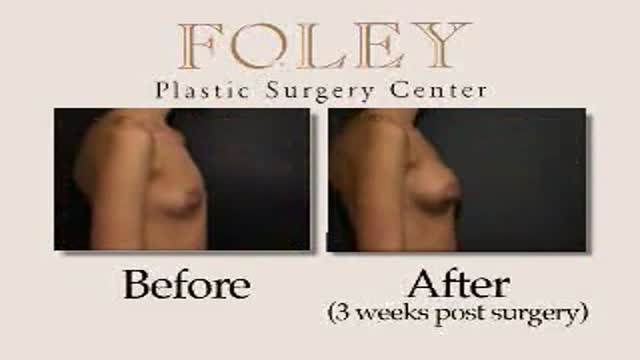Breast Augmentation Surgery