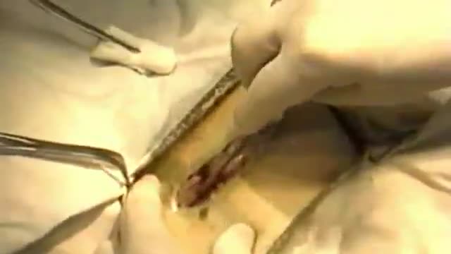 RARE Open Appendectomy Video