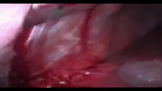 Hemostasis and cauterization during laparoscopy