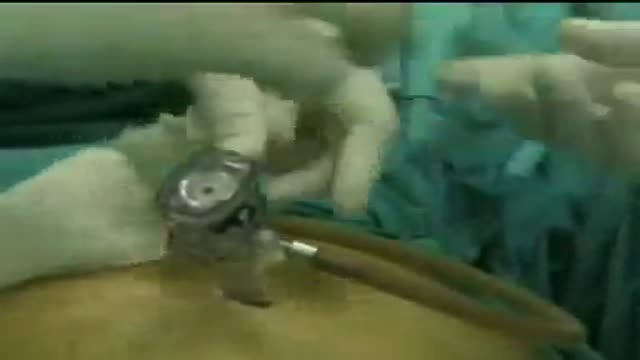 Inserting main port in laparoscopy