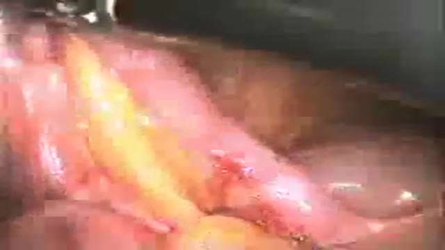 laparoscopic appendcectomy
