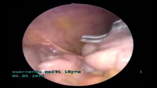 Subhepatic appendicitis