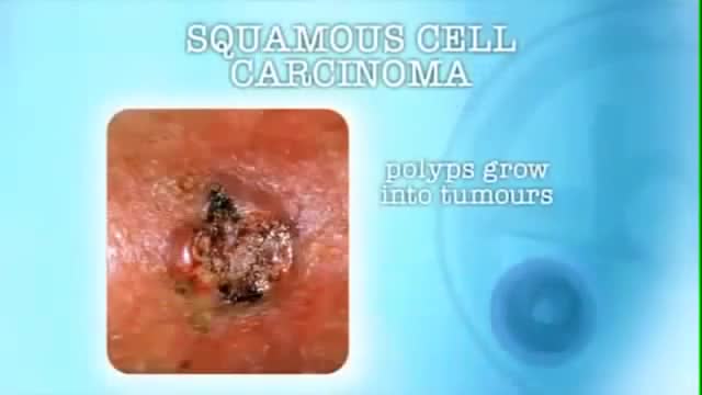 Aggressive face squamous cell cancer