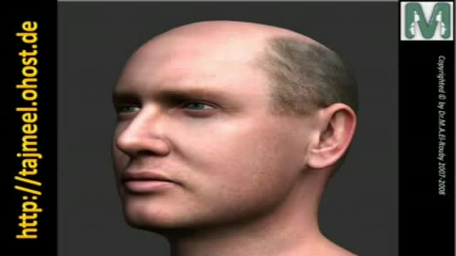 ⁣Hair Restoration (ARABIC)  د. محمد الروبى  زراعة الشعر