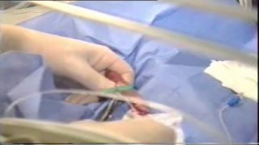 ⁣Catheters & Long Lines in Neonates