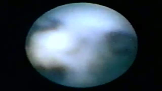 Mammary Ductoscopy