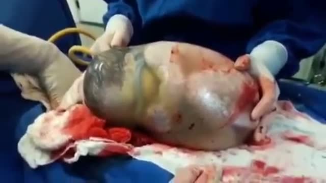 Incredible: Baby Born Still Inside Amniotic Sac