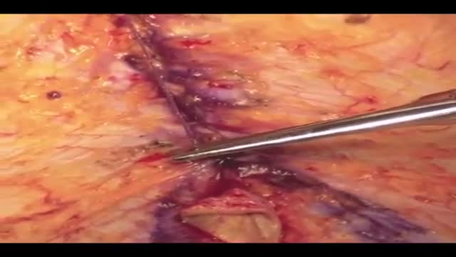 ⁣Barbed Suture Technology in Plastic Surgery