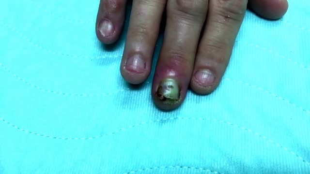 ⁣Finger infection Drainage