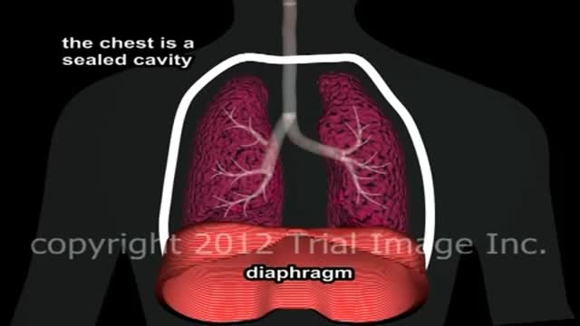 ⁣Pulmonary Edema