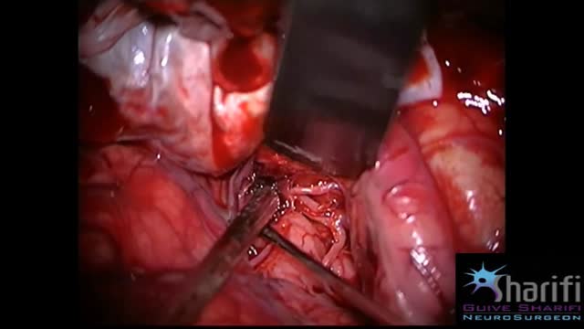 ⁣Aneurysm Clipping
