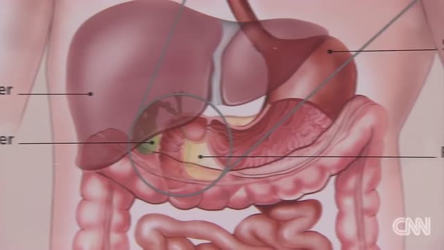 ⁣Irritable Bowel Syndrome