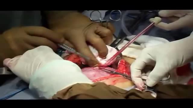 ⁣Emergency C Section for a Bleeding Placenta