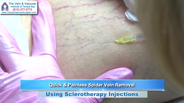 ⁣Spider Vein Sclerotherapy Injections