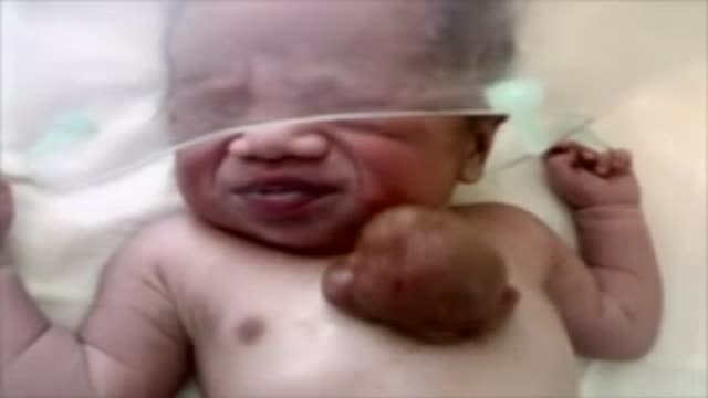 Baby Born with Beating heart outside chest