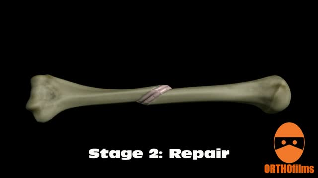 ⁣Bone Fracture Healing