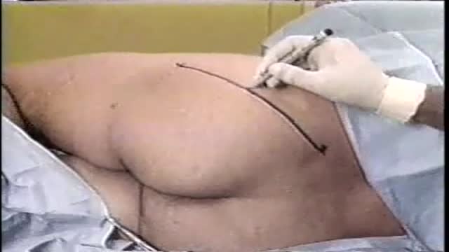 ⁣Sciatic Nerve Block