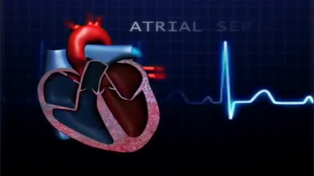 ⁣Atrial Septal Defect