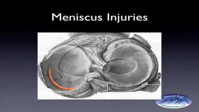 ⁣Meniscus Tear and Repair with Sutures