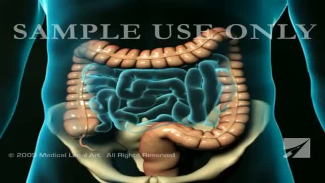 Appendicitis Surgery