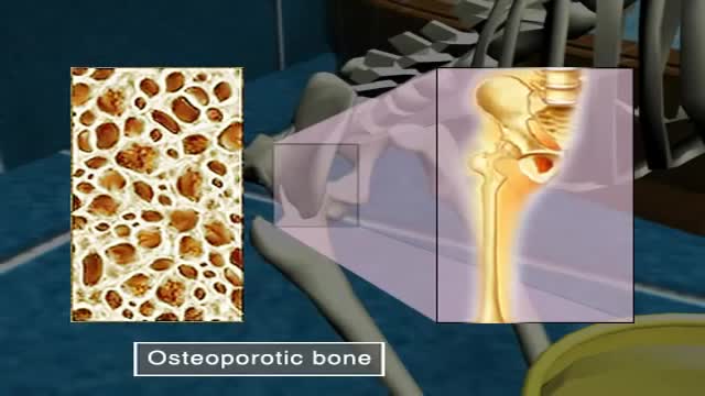 ⁣What is Osteoporosis?