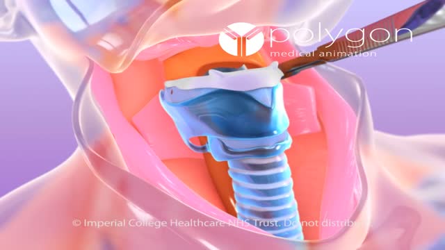 Laryngectomy