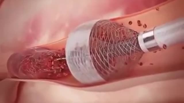 ⁣Removing Blood Clot From the Artery or Veins