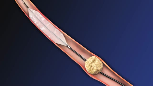 ⁣Stone Control Catheter