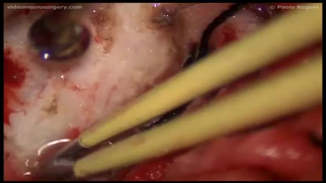 ⁣Chordoid meningioma