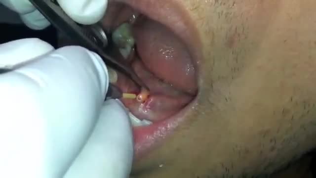 ⁣Laser- Removal of Salivary Stone