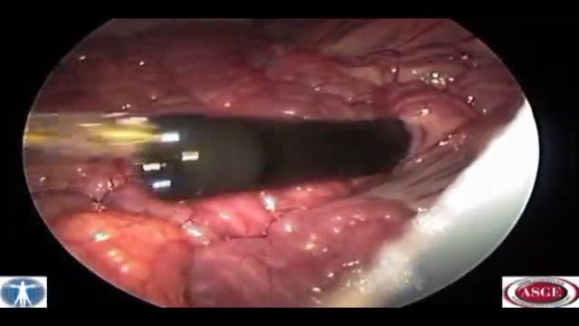 ⁣Endoscopic Transgastric Distal Pancreatectomy