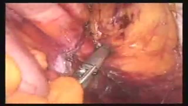 ⁣Colectomy Anterior Approach