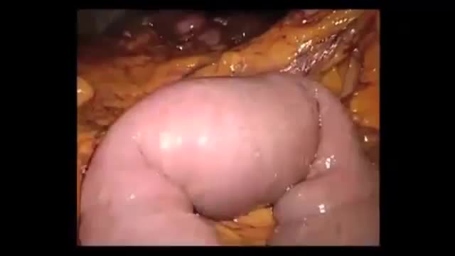 ⁣Biliary ileus