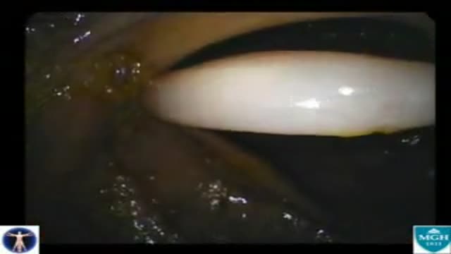 Colon Ascaris Lumbricoides