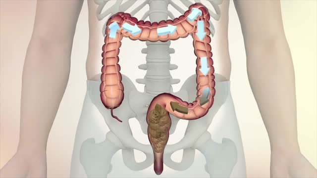 ⁣Colon cancer: