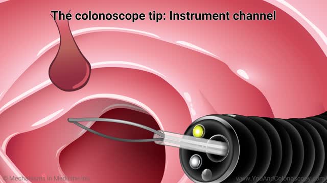 ⁣What happens during and after a colonoscopy?