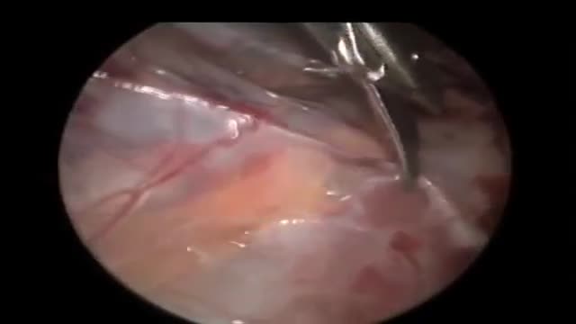 ⁣Laparoscopic Orchiopexy