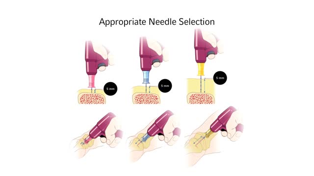 ⁣Infant Child Needle Selection and Insertion Technique