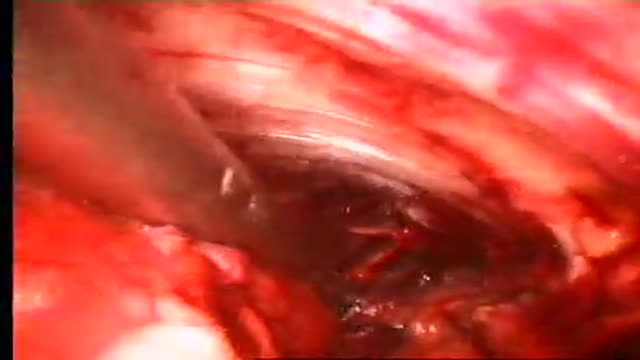 Subfascial endoscopic perforator vein surgery